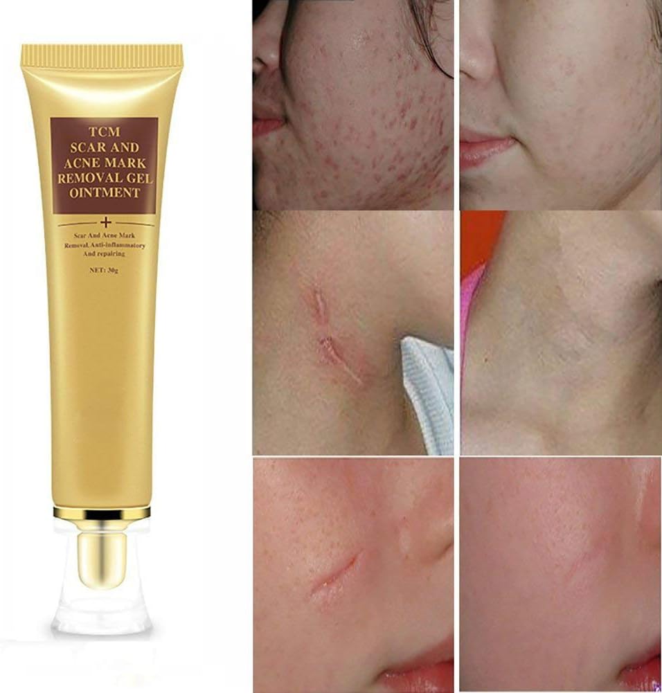 SkinRosa Scar Removal Cream and Acne Treatment Cream – Effectively ... - Acne Treatment That Removes Red Marks