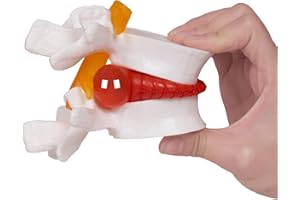 breesky Human Anatomical Lumbar Disc Herniation Model:1.5 Times Life Size Lumbar Disc Teaching Model Tool-for Medical &Teaching & Learning and Scientific Presentations