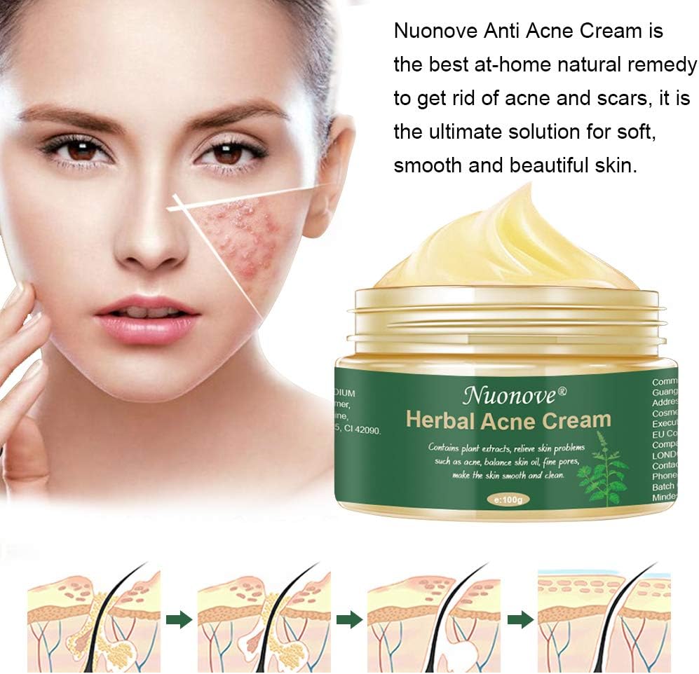 gorsen anti acne cream