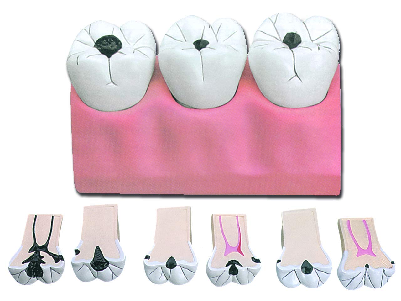 Gima - Anatomical Model of Dental Caries, Highly Detailed, Modular in 7 Parts, Magnification 4 X