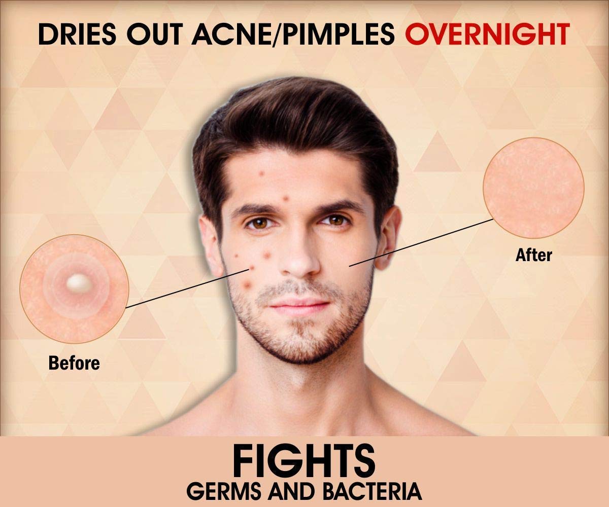 urbangabru acne pimple patch