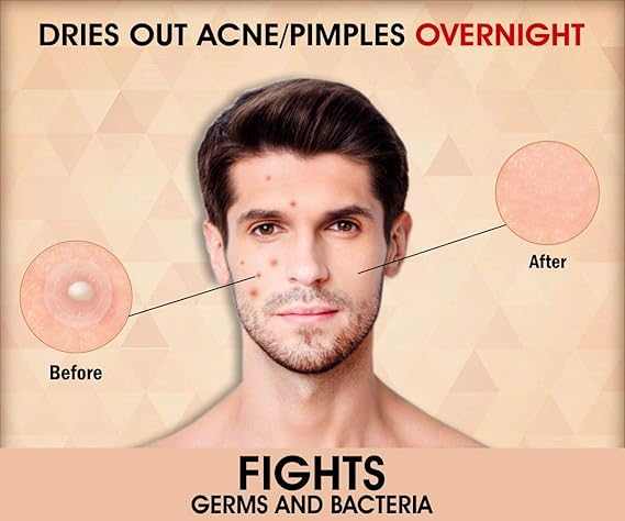 urban gabru pimple patch