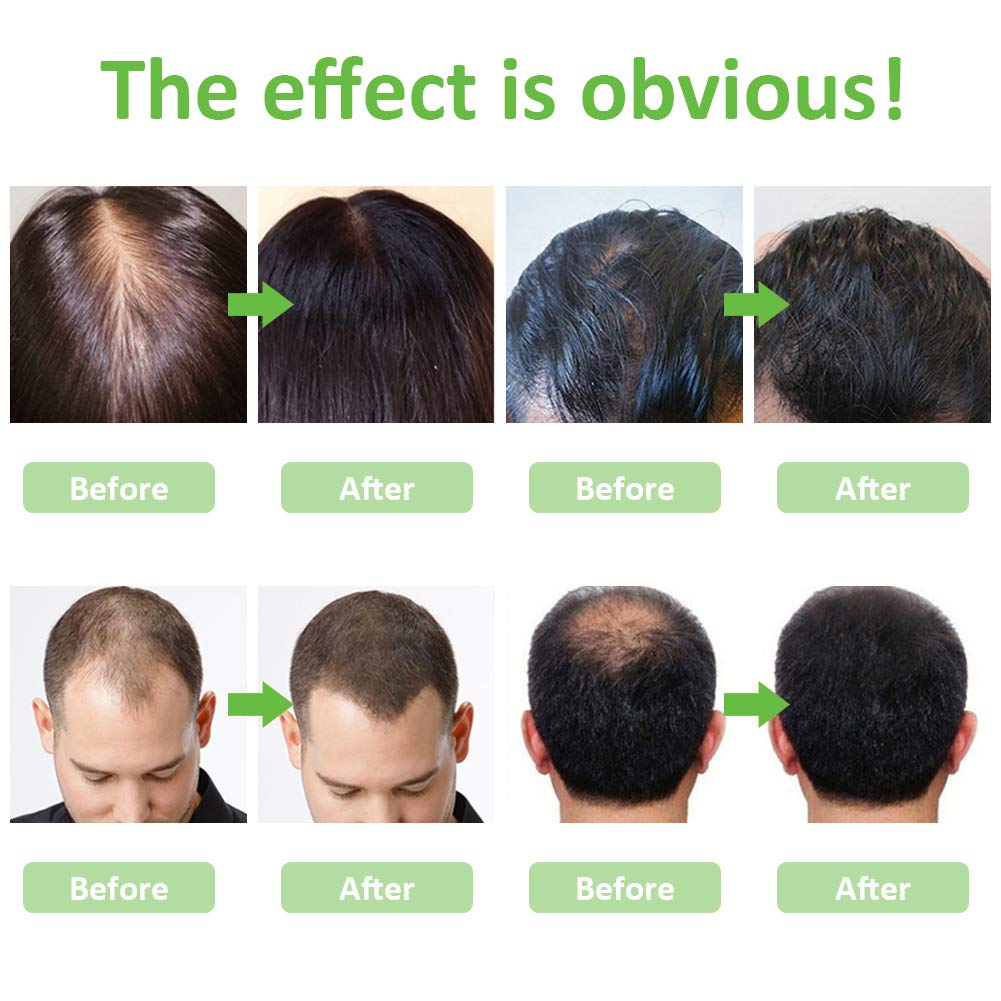 Hair Growth Serum, Hair Loss and Hair Thinning Treatment, Stops Hair Loss, Natural Herbal Essence, Thinning, Balding, Repairs Hair Follicles, Promotes Thicker, Stronger Hair and New Hair Growth(50ml) : Beauty