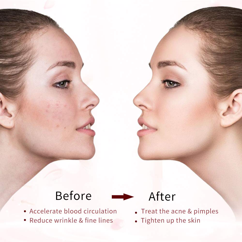 Signstek Portable High Frequency Face Wand Facial Machine for Skin Tightening, Acne Wrinkles Remover, Puffy Eyes: Beauty