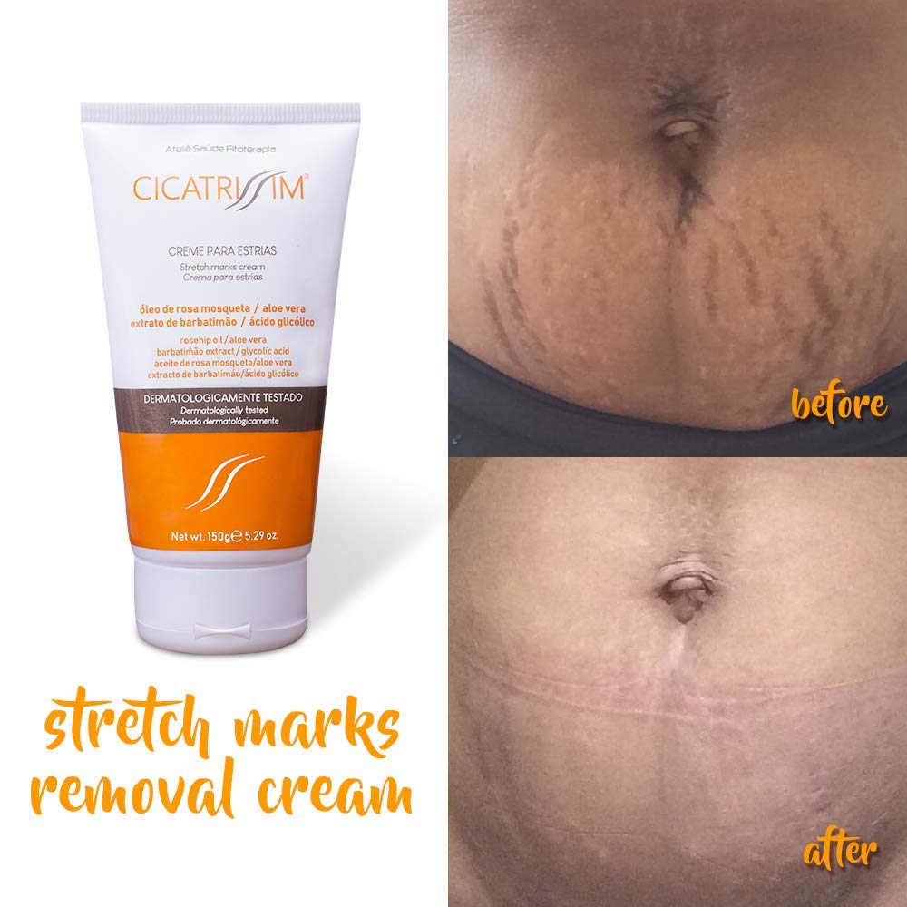 crema para stretch marks