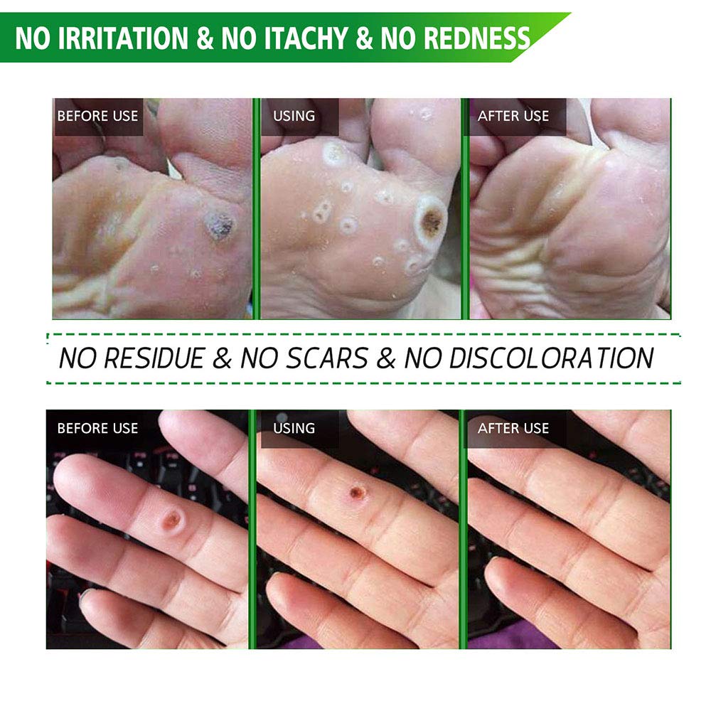 42 Pads Corn Removers for Feet-Corn Remover Pads-Toe Corn and Callus Removal- Corn Treatment Pads-Relieve Foot Pain : Beauty