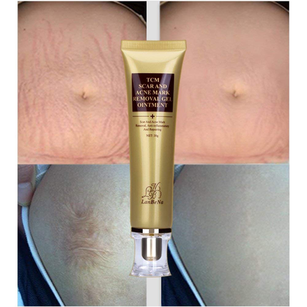lan be na tcm scar and acne mark removal gel ointment
