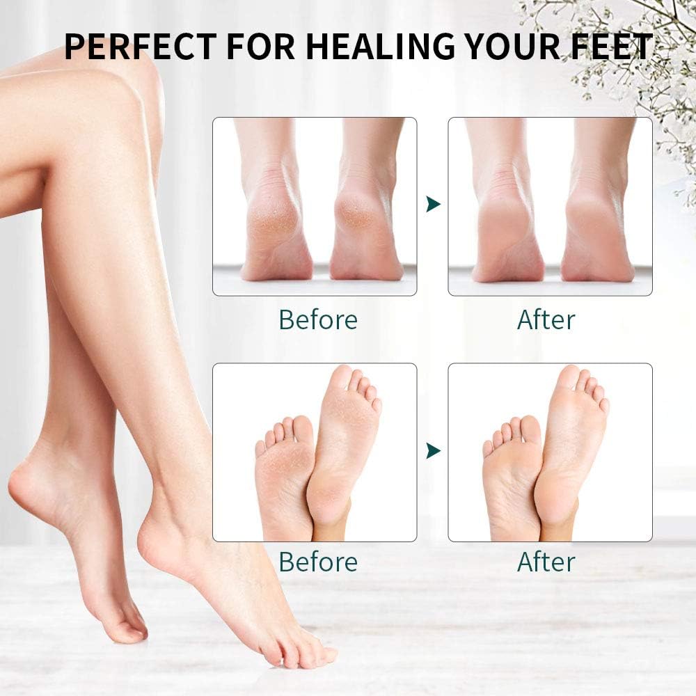 Electric Callus Remover, RUEOO Rechargeable Electronic Feet File Hard Skin Remover IPX7 Waterproof Pedicure Tool for Cracked Heels and Dead Skin, with 3 Coarse Roller Heads Foot Rasp: Health & Personal Care