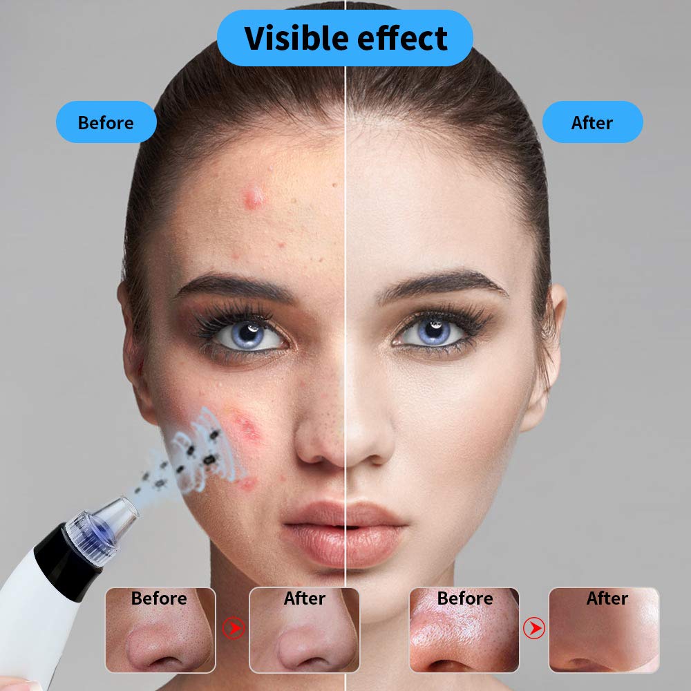 Blackhead Remover,Zdatt Blackhead Vacume Remover -Comedo Pore Extracotr Beauty Device with 5 Probes for Blackhead Remover Vacume Suction Cleanser: Beauty