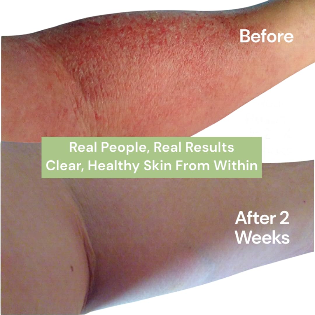 Loma Lux Eczema Pills – Natural Eczema Treatment Relief Remedy – Dermatologist Developed – 7 Minerals Clear & Prevent Severe Eczema Scaling, Rash, Anti Itch Skin Body Face for Adults, Kids, Toddlers