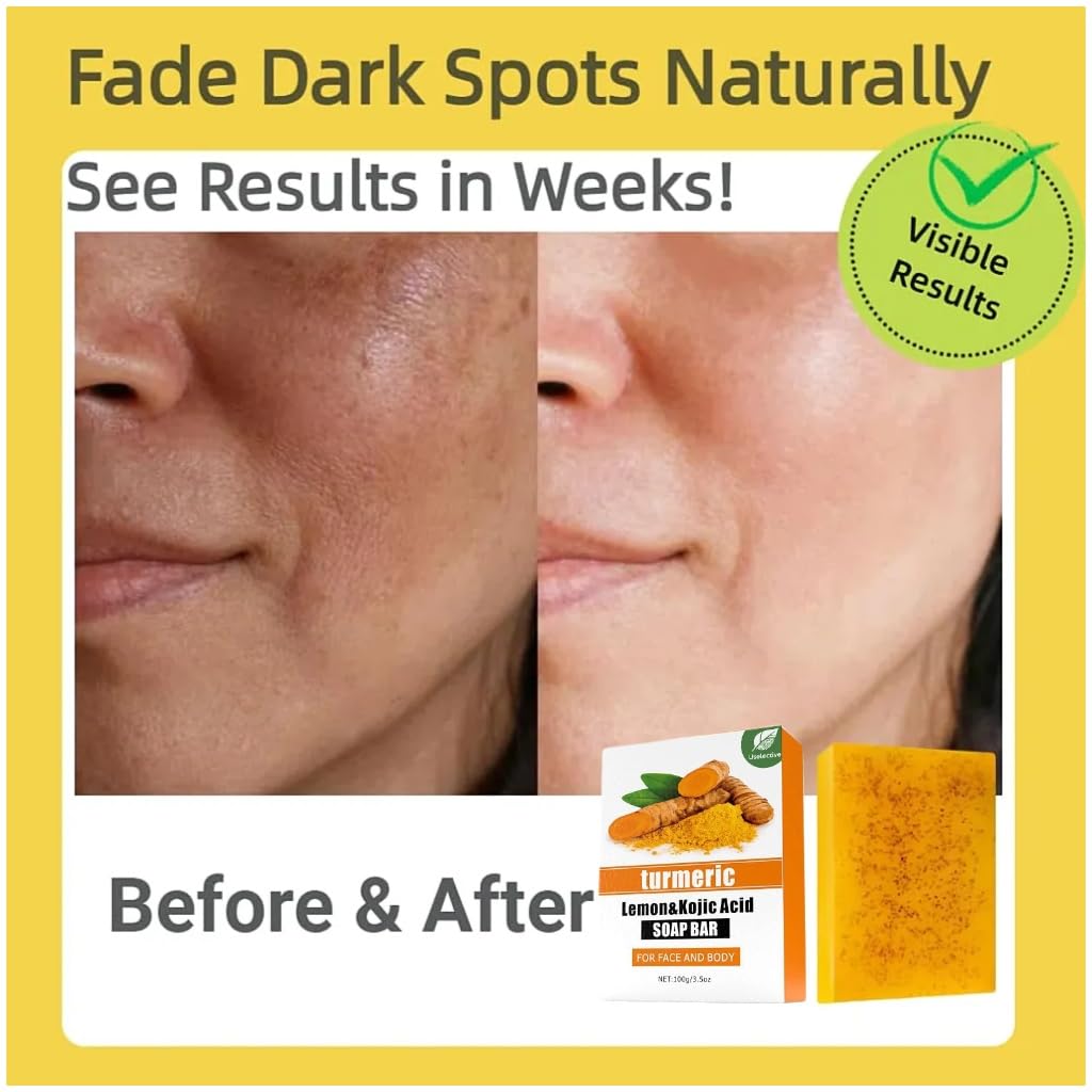 Kojic Acid & Turmeric Soap Bar for Dark Spot removal - Skin Lightening Soap with Vitamin C, Retinol, Shea Butter & Lemon Oil - for Face, Body, Underarms - SLS Free, for Oily & Dry Skin