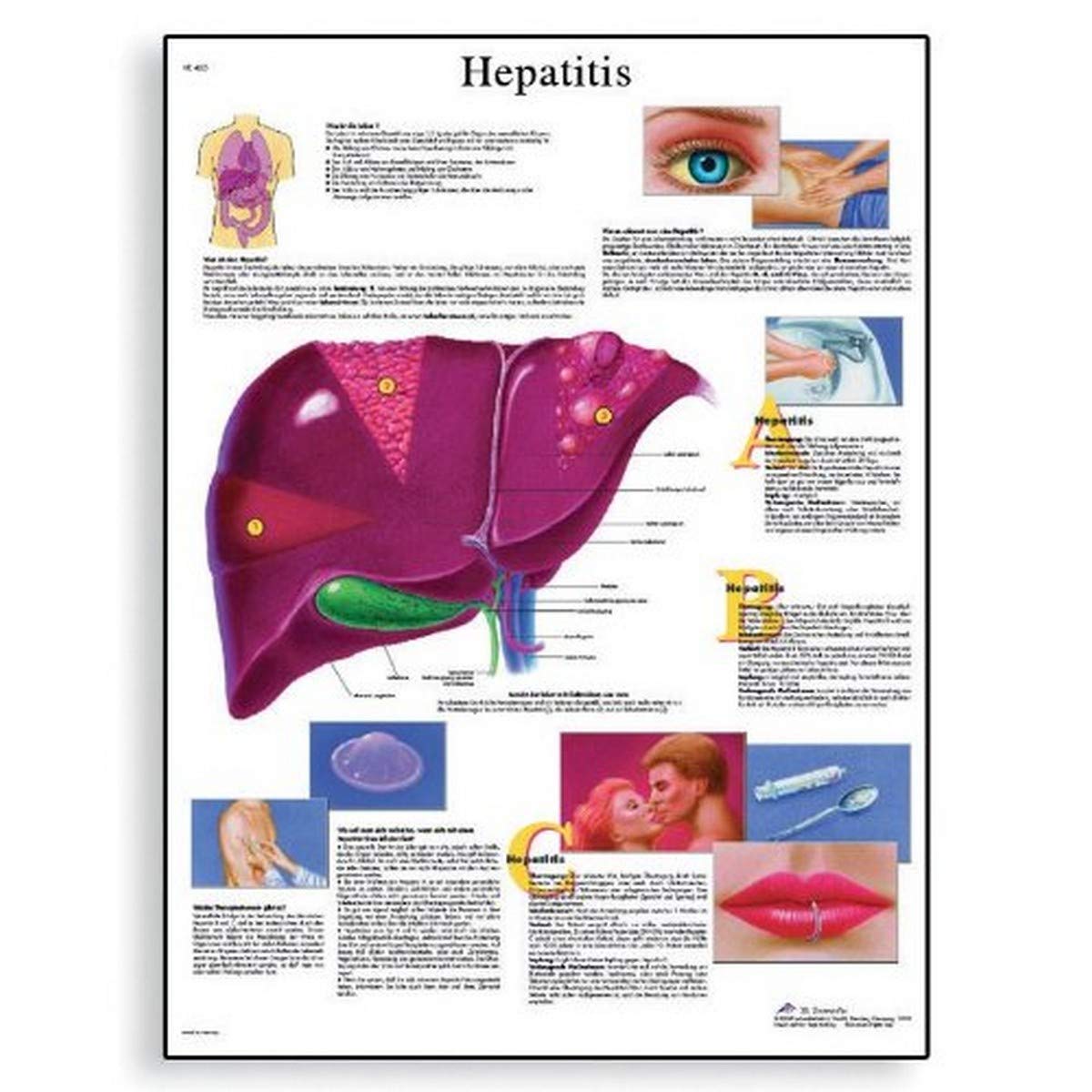 3B Scientific Human Anatomy - Hepatitis Chart, Paper Version