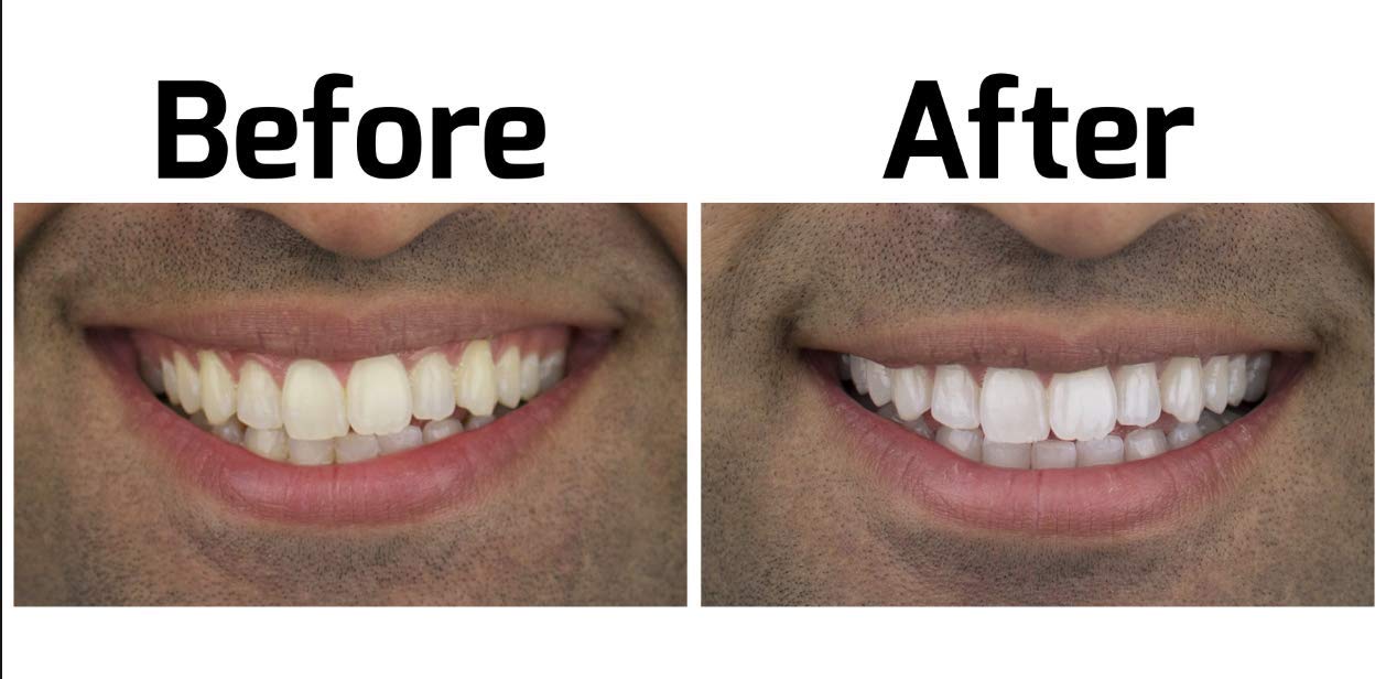 Opalescence Go 15% Teeth Whitening Trays (Boxed, 10 pack ... Opalescence Go 15% Teeth Whitening Trays (Boxed, 10 pack ...