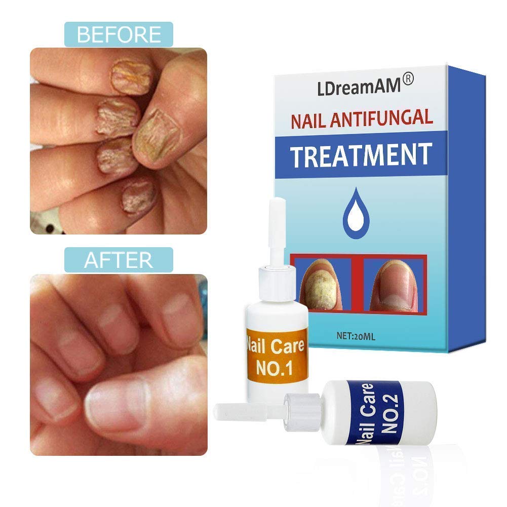 Buy Nail Fungus ,Fungus Stop,Nail Antifungal ,AntiFungal Solution