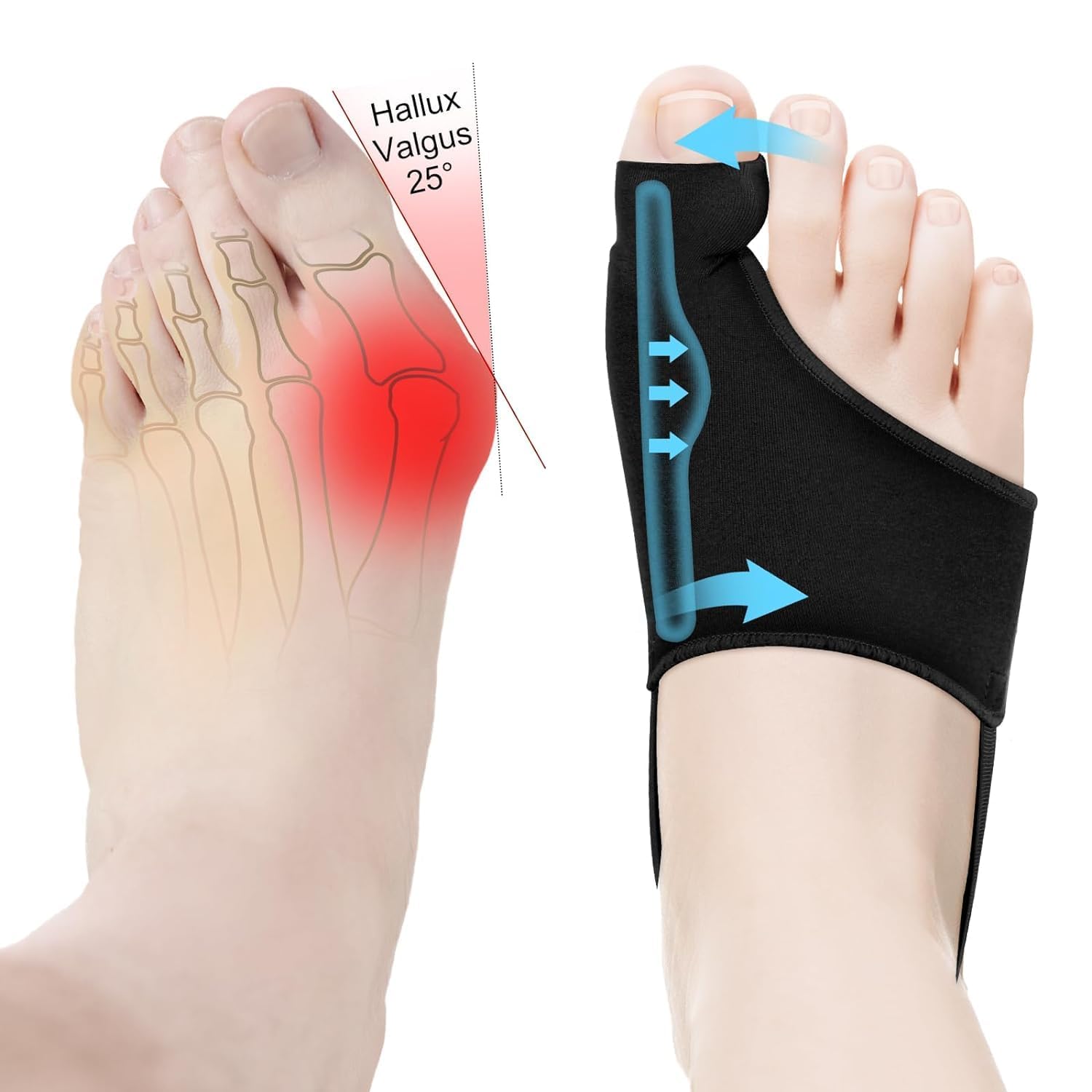 Photo 1 of 2 Pcs Bunion Corrector For Women Big Toe Straightener Relief For Men and Woman, Relief Splints Reduce Pain And Correct Toe Alignment, Recovist Bunion Corrector Fit For R/L, Washable (Black)