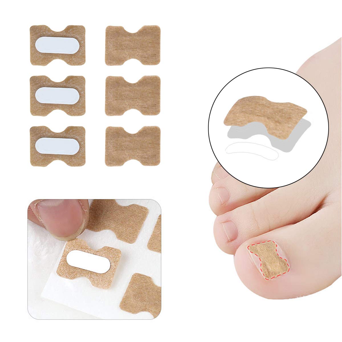 Ingrown Toenail Tools Kit, Include 2pcs Ingrown Toenail Correction Buckle and Toenail Lifter, 2 Sheets Ingrown Toenail Correction Patches for Ingrown Toe Nails Foot Care Tools: Beauty