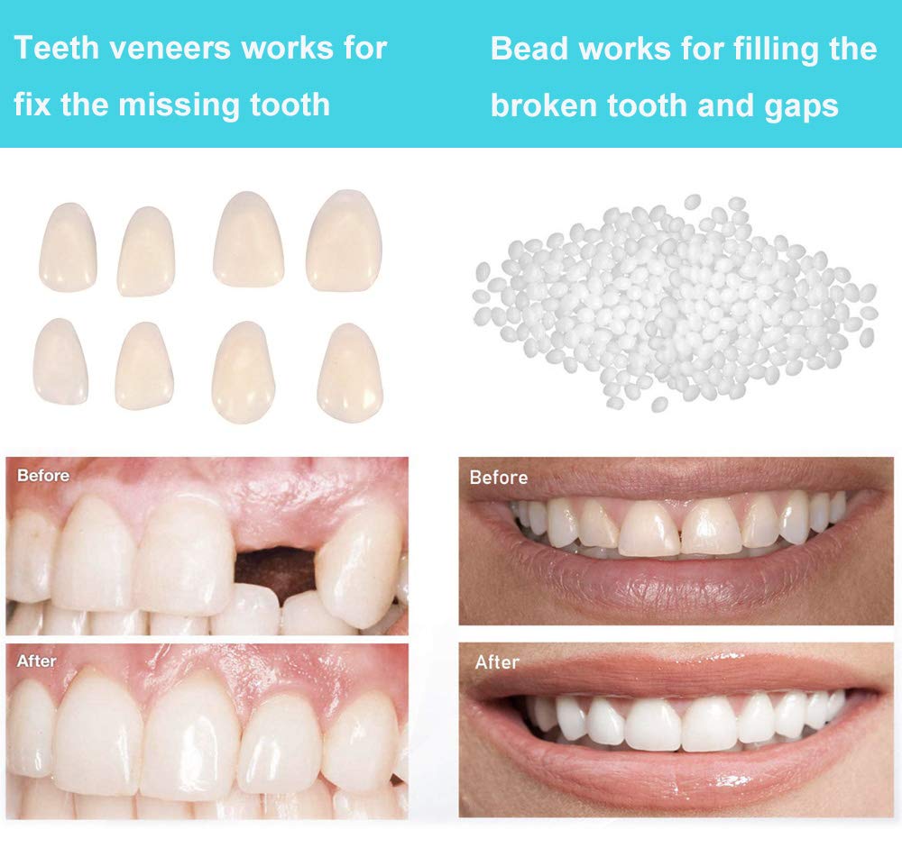 Brige Temporary Tooth Repair kit for Fix Filling the Missing Broken Tooth and Gaps-Moldable Fake Teeth Veneers and Thermal Beads Replacement Kit, Artfifical Teeth : Beauty
