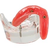 Dental Implant Model, Lower Jaw Overdenture, Removable Overdenture, with 2 Implants,M6002