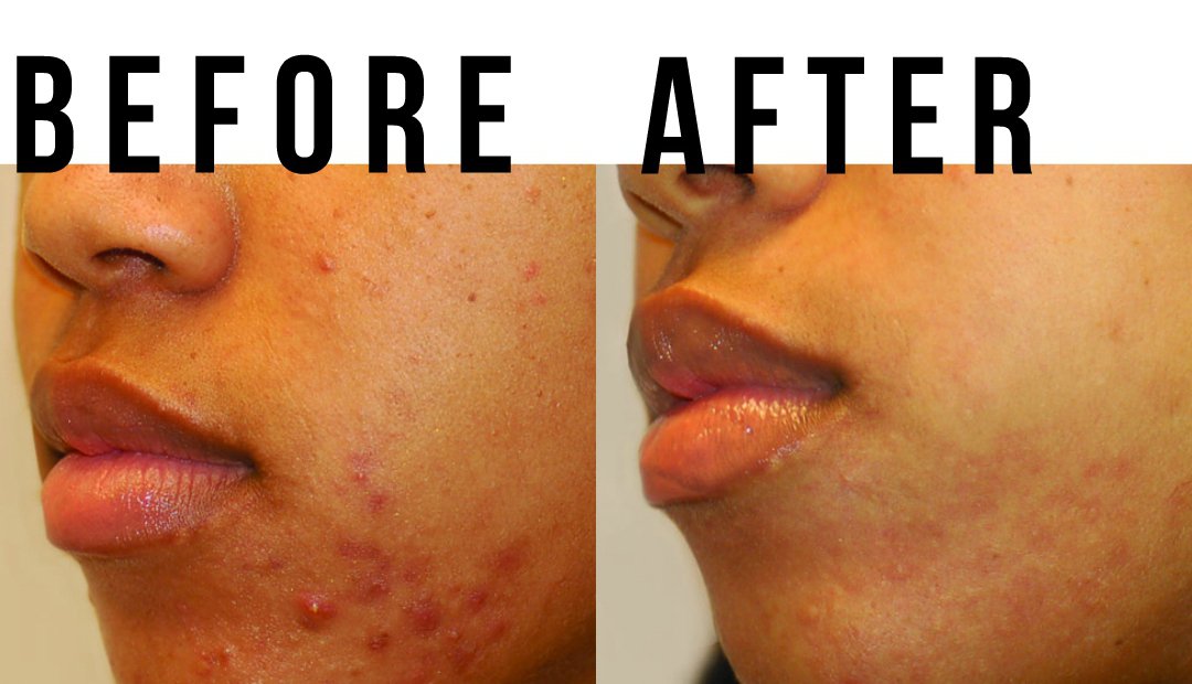 dr lin acne treatment