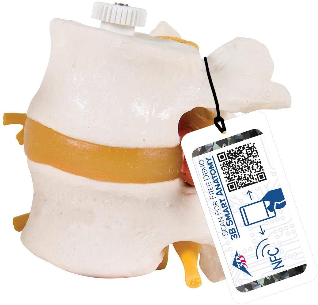 3B Scientific 2 Lumbar Vertebrae with Prolapsed Disc Flexibly Mounted + free anatomy software - 3B Smart Anatomy