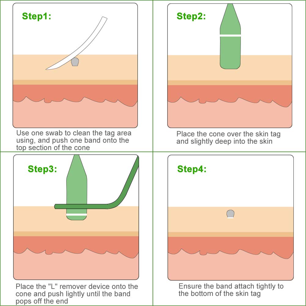 Micro Skin Tag Remover Device for Small to Medium Skin Tags : Beauty