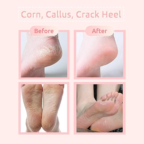 BPrettier Callus Remover for Feet OZ Extra Strength Callus