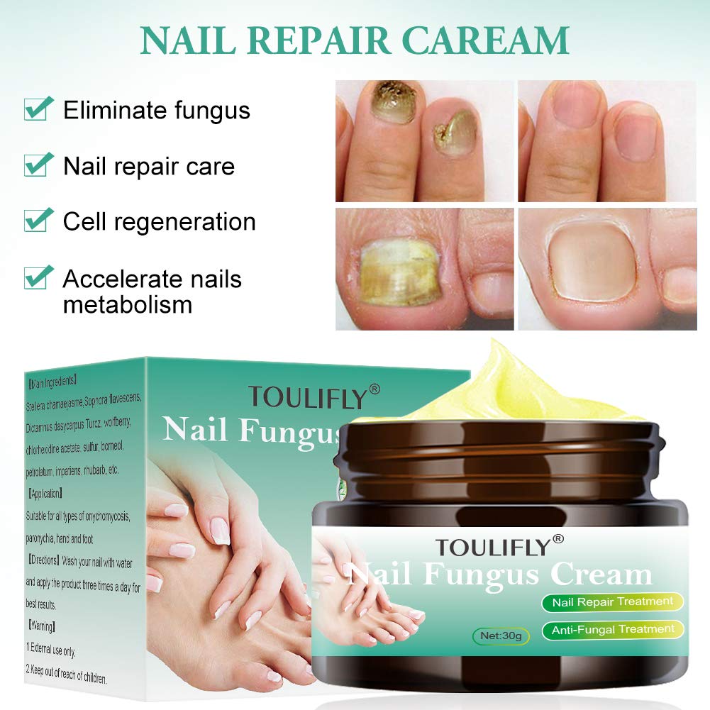 Toenail-Fungus-TreatmentNail-Fungus-TreatmentNail-Fungus-CreamNail-Fungus-RemoverToenail-Fingernail-Fungus-Treatment-Fungus-Stop-Nail-Care-Repair-Cream