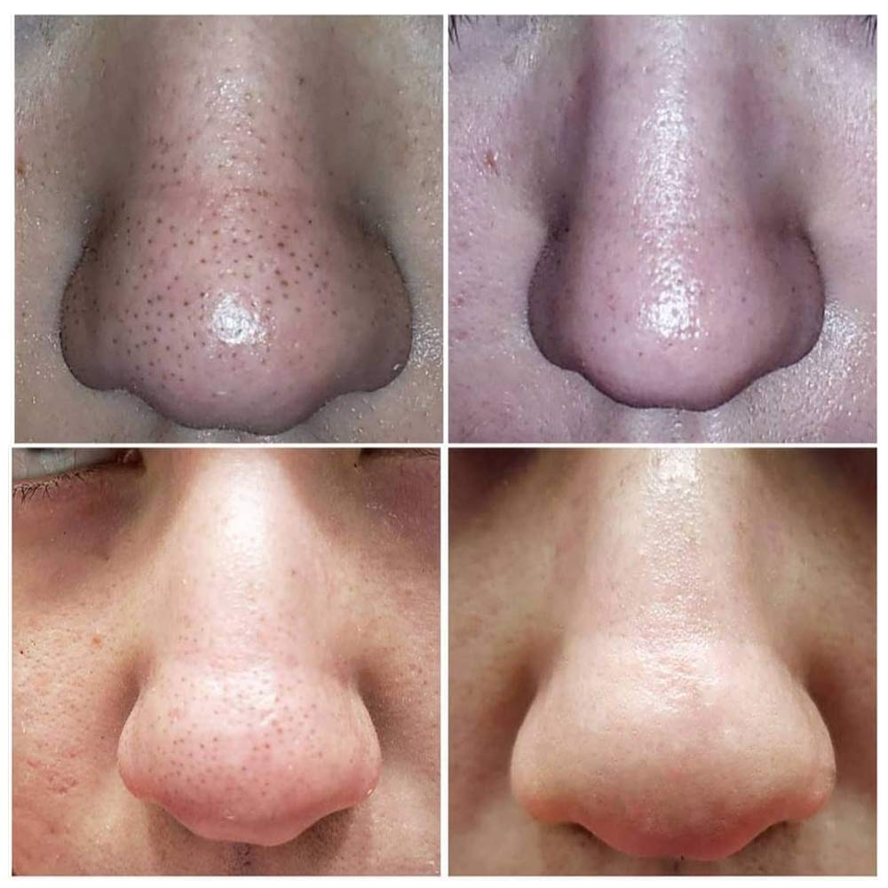 Blackhead Vacuum - Pore Vcauum Blackhead Remover Comedone Extractor Tool and Facial Skin Cleaner Suction Microdermabrasion Machine