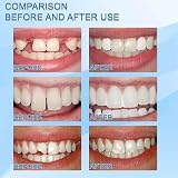 selcouth yyds Temporary Tooth Repair Kit Silicone Denture Beads 30ml view 5