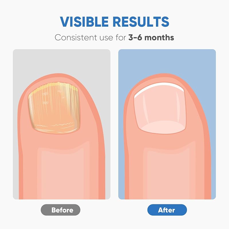Dispositif de Laser pour Mycose Des Ongles, Berrlly Dispositif des Champignons des Ongles Portable Lumière Bleue 460nm Très Efficace, Facile à Utiliser à Maison pour Améliorer Ongles Endommagés (Noir) — photo 3 sur 8