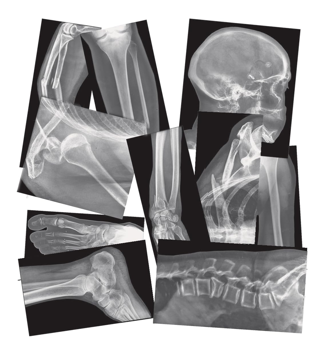Roylco Broken Bones X-Ray Set, Projector Display Compatible, 15 X-Rays