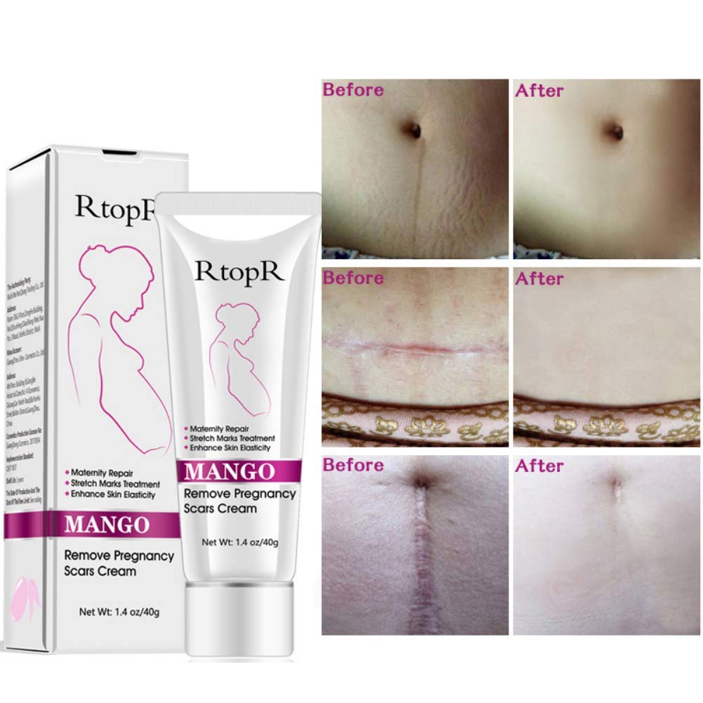 mango anti stretch mark cream