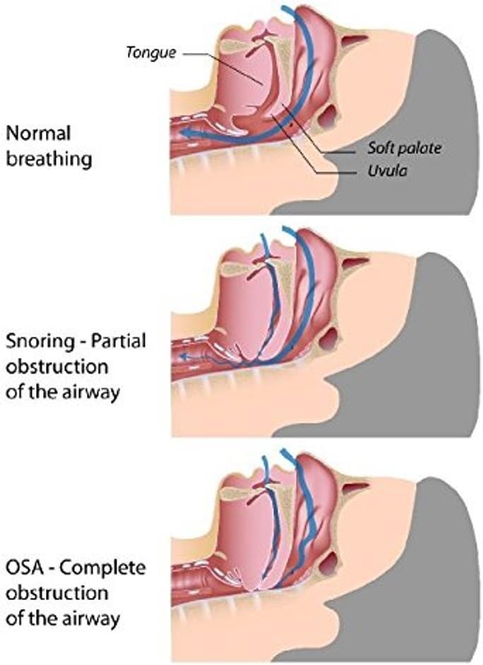 Professional Anti Snore Chin Strap Adjustable - The #1 Ranked Device Instant Snore Stopper: Health & Personal Care