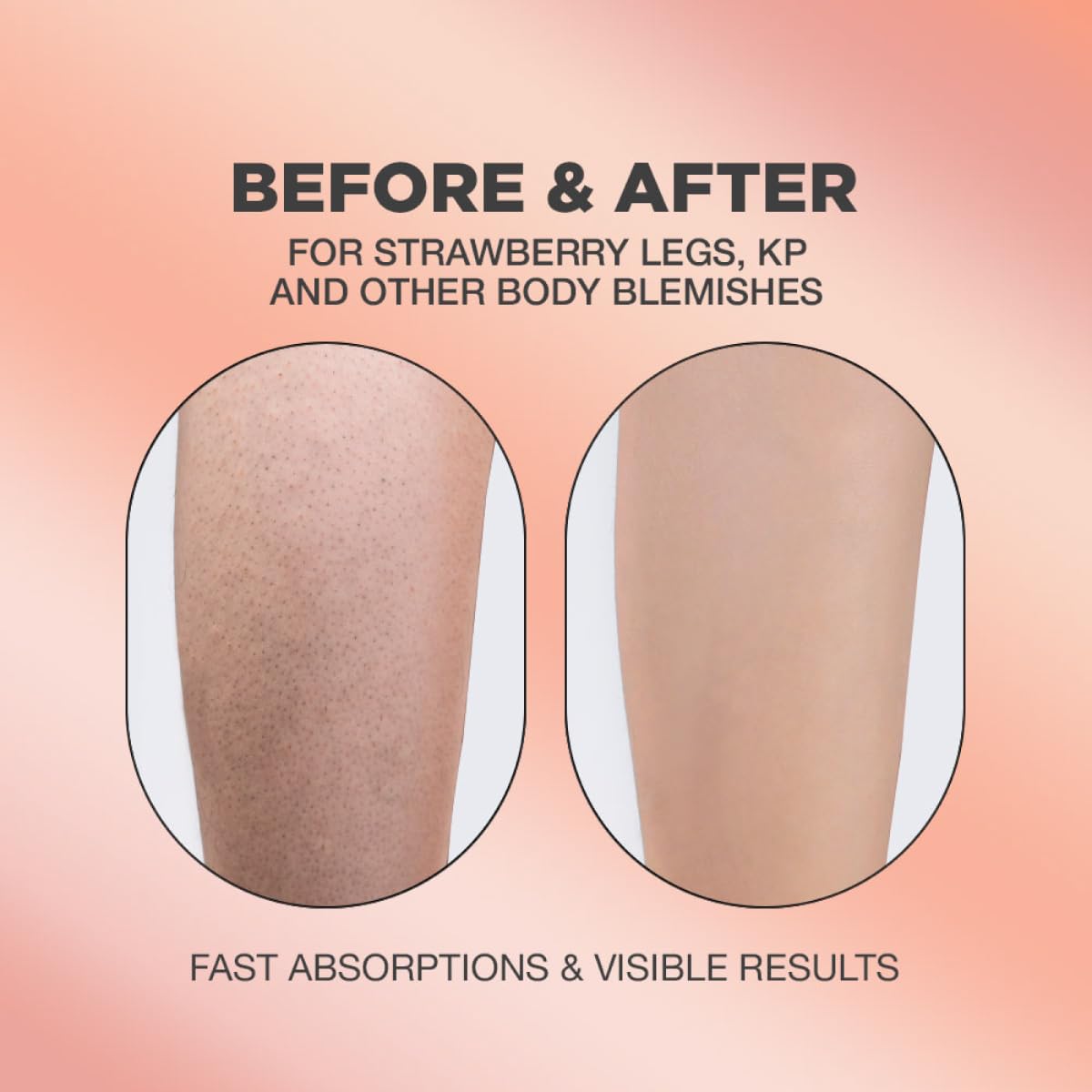 Strawberry Legs Treatment For Women Body Serum | Strawberry Legs Treatment For Women Exfoliating Body Serum | Chicken Skin Treatment Body Serum | Targets Strawberry Legs Treatment For Women