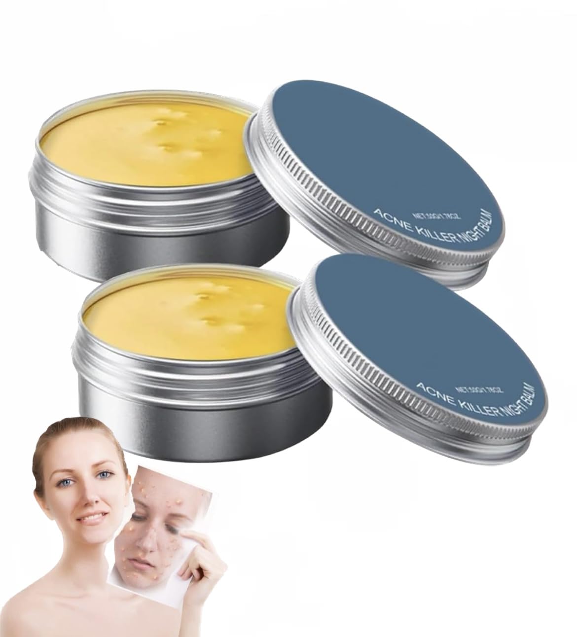 Norse Organics Acne Balm, Redness & Acne Killer Cream for Men (2 Pcs)