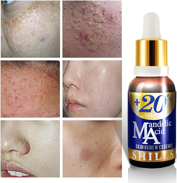 mandelic serum for acne