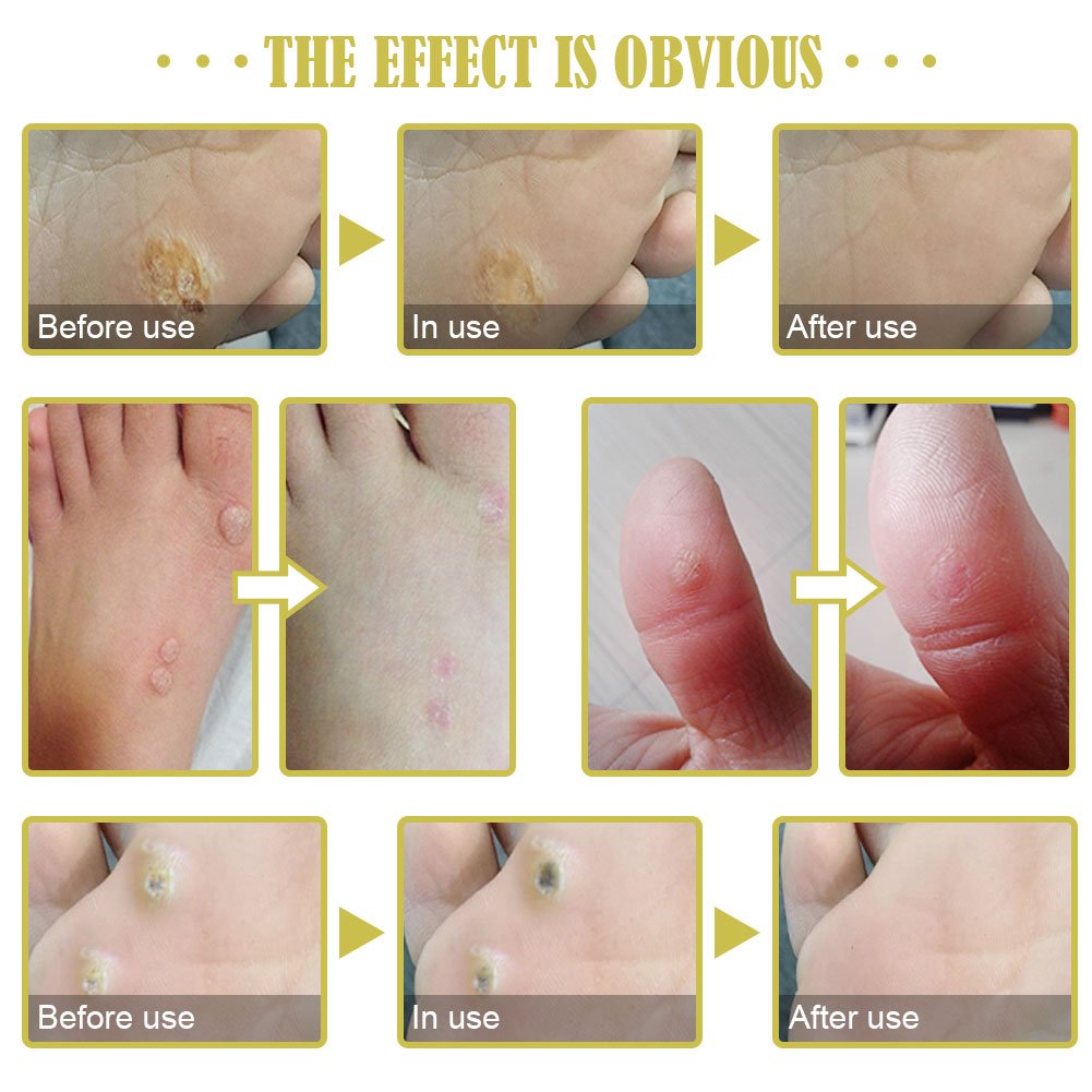 Corn Remover Pads, Corn Removal, Corn Remover, Corn Wart Remover, Corn Callus Remover, It is a Better Solution for People Who Suffer The Pain of Corn, 12Pcs/Box : Beauty