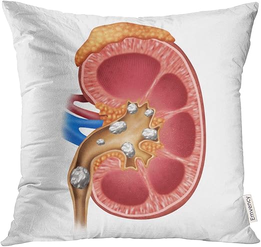 Amazon Com Emvency Throw Pillow Cover Kidney Stones Medical As