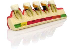SEUJJRO Teeth Periodontal Disease Model Dental Caries Breakdown Display Periodontitis Show Teaching Tooth Model Dentist Odontologia Communication