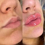 Plump It! No Needles Lip Filler Kit Original Gloss Instant Long-Term Fuller view 6