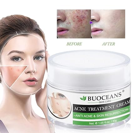 pimple solution cream