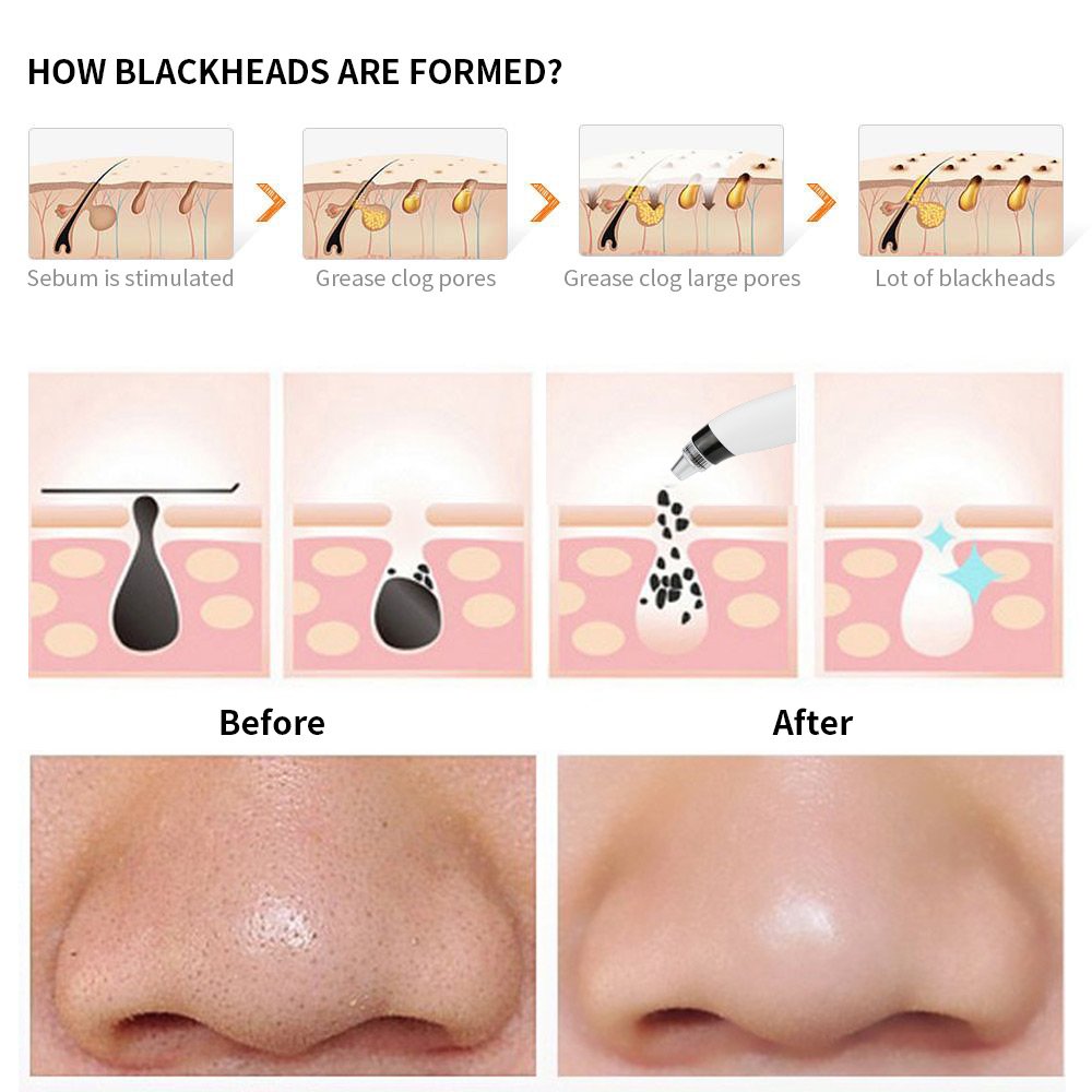 Blackhead Remover,Zdatt Blackhead Vacume Remover -Comedo Pore Extracotr Beauty Device with 5 Probes for Blackhead Remover Vacume Suction Cleanser: Beauty