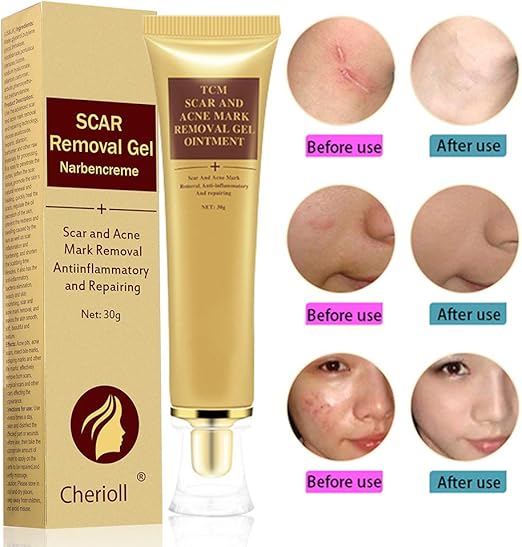acne scar healing cream