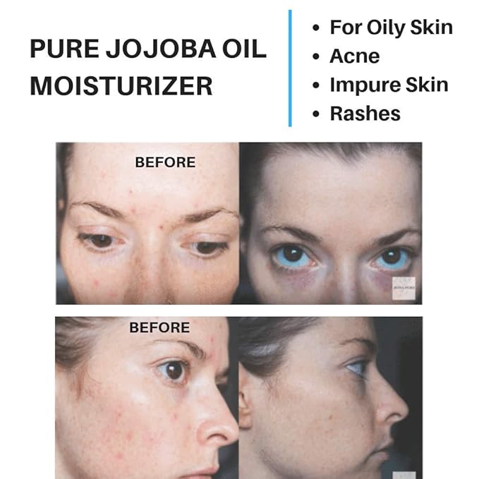 jojoba oil for oily acne prone skin