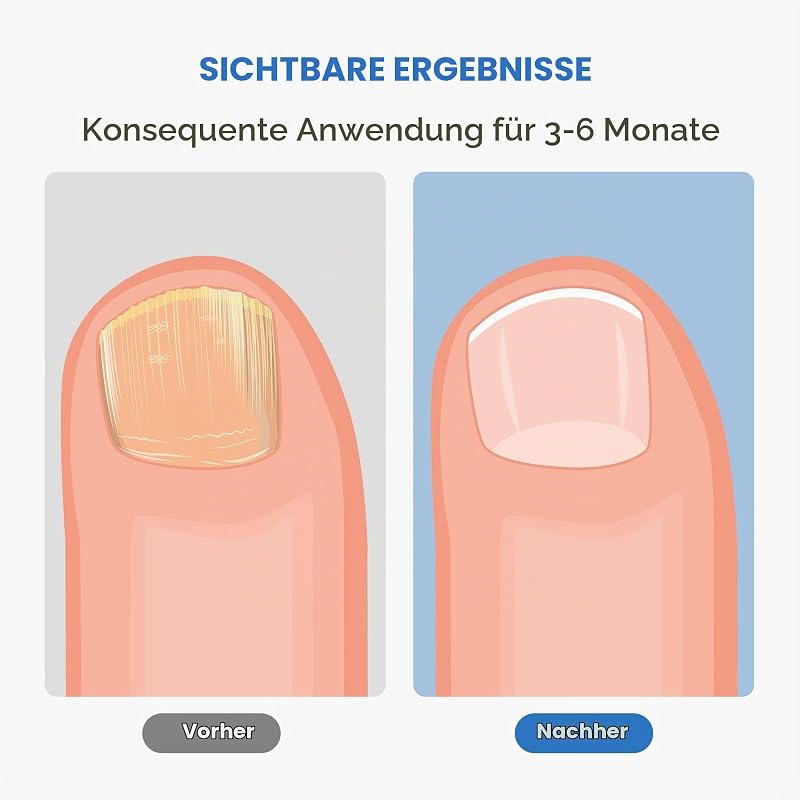 Nagelpilz Blaulicht Gerät, tragbares Nagelpflegegerät mit USB-C, 460nm Blaulicht für Finger- und Zehennägel, einfache Anwendung zu Hause, Schwarz — Foto 3 von 8
