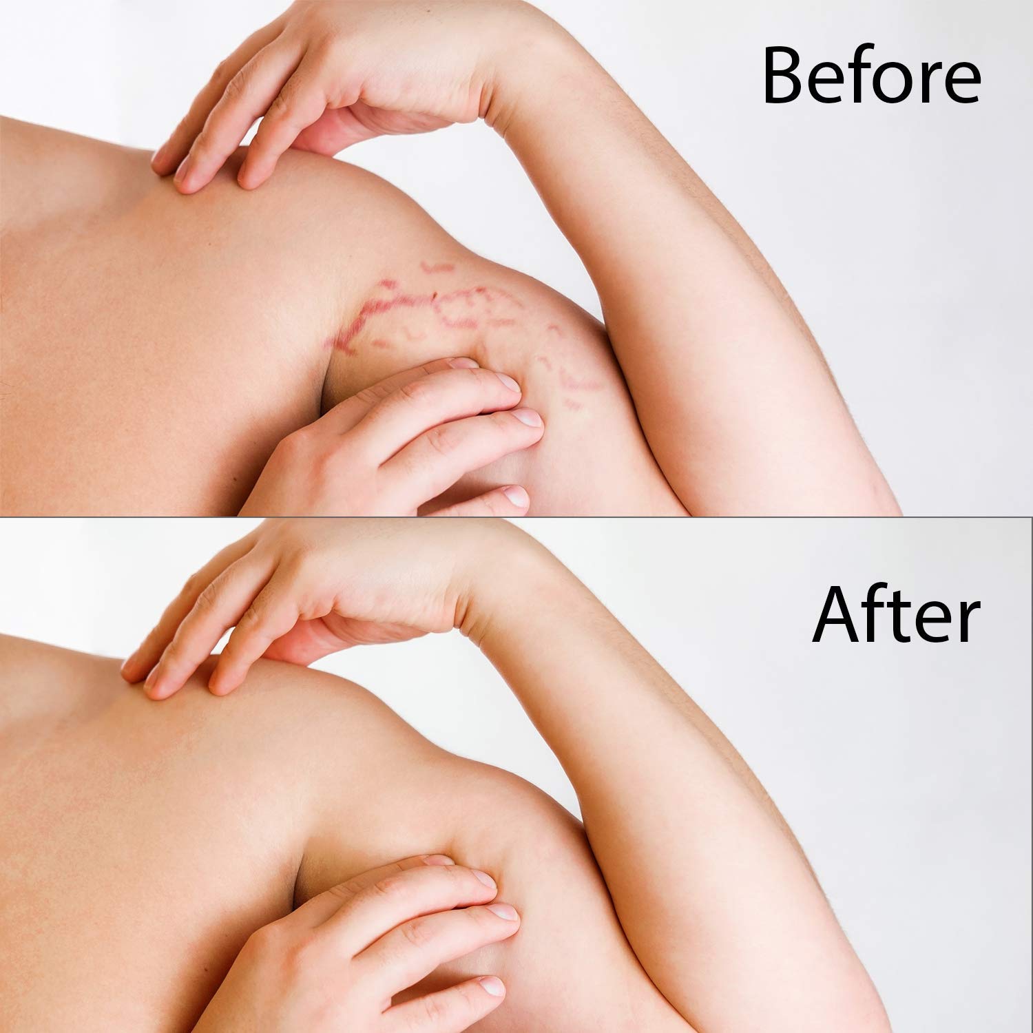 mederma advanced stretch mark therapy