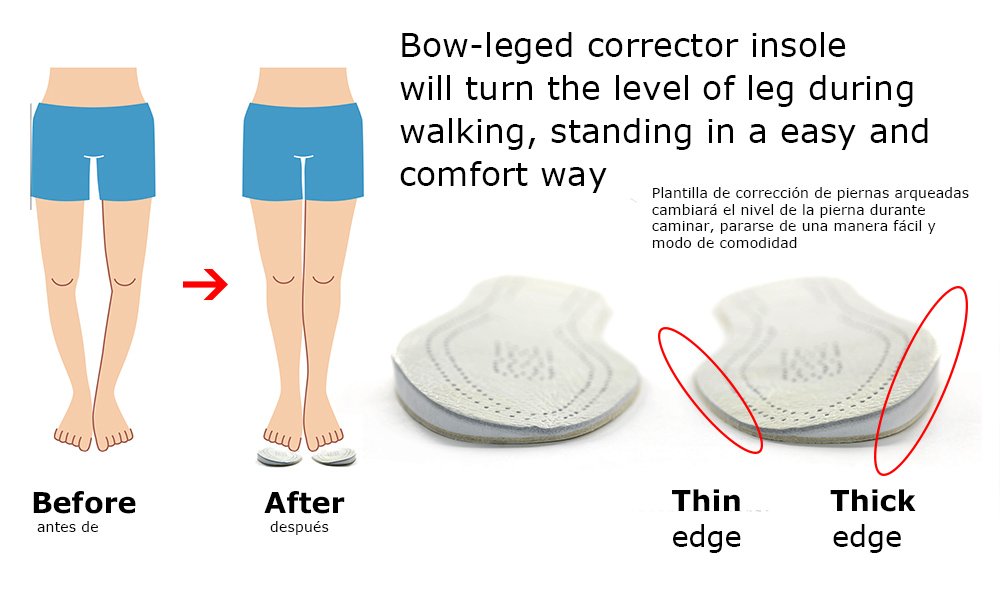 Amazon.com: USFOOT® Orthotics Bow Leg Insole (Genu varum), Bow Leg Corrector, Knock keen Corrector, Genu varum Shoes Insole (1 Pair) (Medium) US Size Men; ...