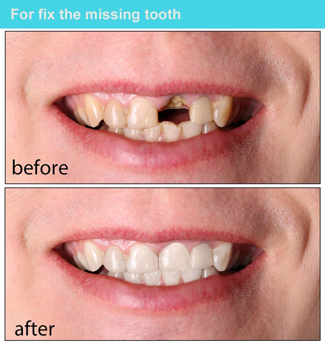 Brige Temporary Tooth Repair kit for Fix Filling the Missing Broken Tooth and Gaps-Moldable Fake Teeth Veneers and Thermal Beads Replacement Kit, Artfifical Teeth : Beauty