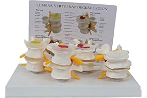 SHENGANG Human Spine Model 4-Stage Diseased Lumbar Spine Comparison Model of The Stages of Spinal Disc Diseases Disc Bone Disc Degeneration Advanced Osteoporosis