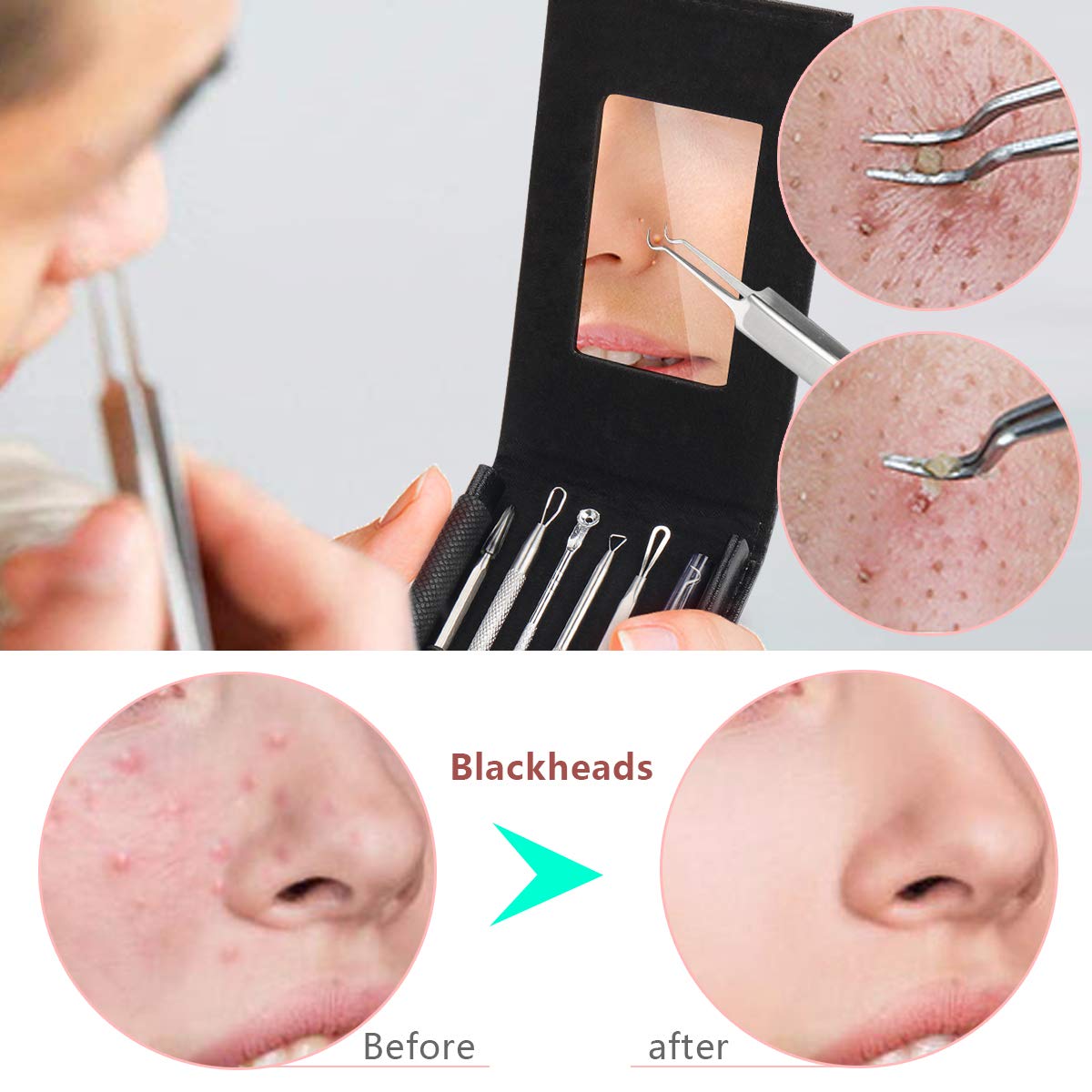 Pimple Popper Tool Kit,Blackhead Remover kit,christmas gifts Stocking Stuffers 6 PCS Ingrown Hair Removal Kit,White heads Removers,Pore Extraction Tool,Facial Skin Acne Zit Tools With A Leather Bag: Beauty